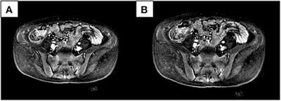 Comparative Analysis of Clinical and Imaging Features of Osteomalacia and Spondyloarthritis